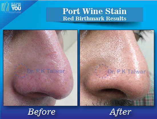 Port Wine Stain Results
